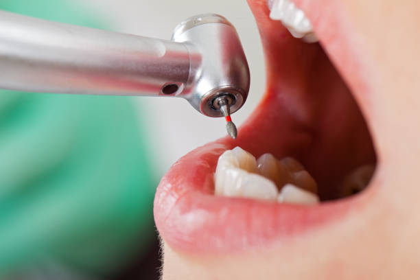 Best Broken or Chipped Tooth Repair in Missouri City, TX
